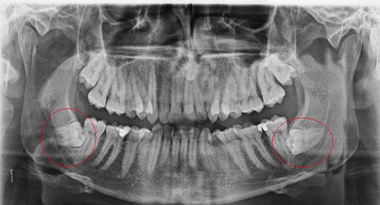 20 Lik Diş Ameliyatı