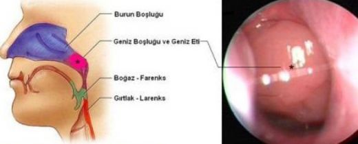 Bebeklerde Geniz Eti Ameliyat