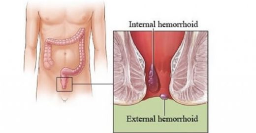 Hemoroid Ameliyat Sonras