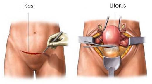Histerektomi Ameliyat