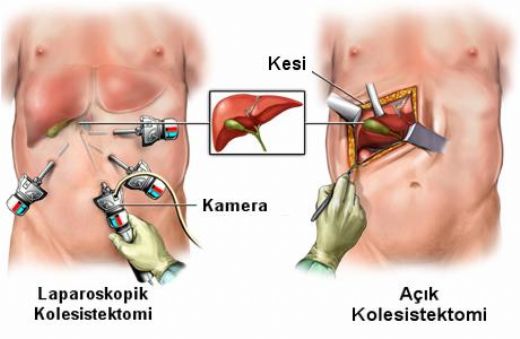 Kese Ameliyat