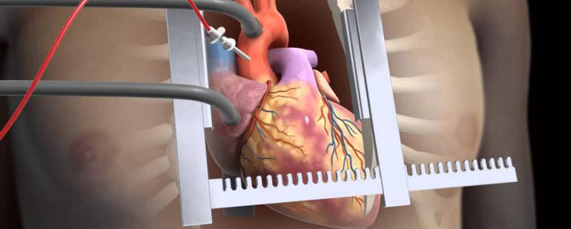Açık Kalp Ameliyatı