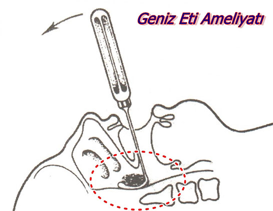 Geniz Eti Ameliyatı Sonrası Dikkat Edilmesi Gerekenler? ameliyatlar