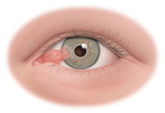 Göz Eti Ameliyatı