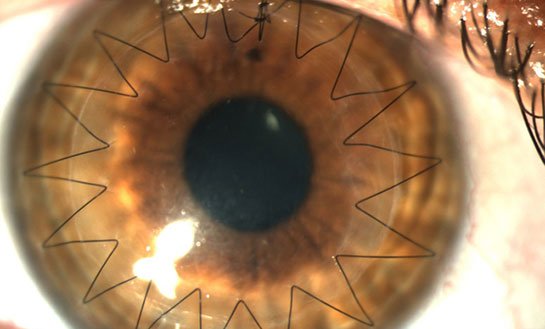 Göz Nakli Ameliyatı