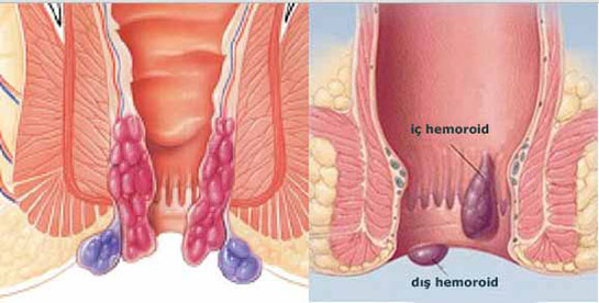 Hemoroid Ameliyat