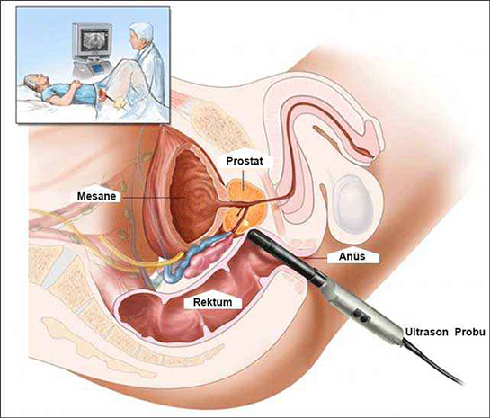 Kapal Prostat Ameliyat