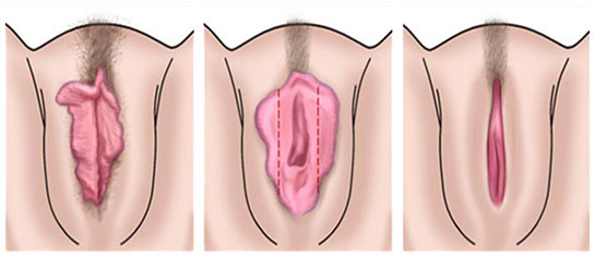 Labioplasti Ameliyat