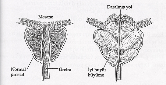 Prostat Ameliyat